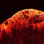 Simple eye scan can reveal extent of Multiple Sclerosis Simple eye scan can reveal extent of Multiple Sclerosis