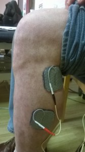 Positioning of electrodes for foot drop