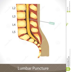 Will the lumbar puncture hurt?