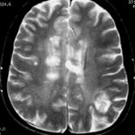 Multiple sclerosis has its lesions and inflammation