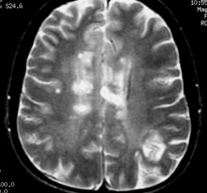 Multiple sclerosis has its lesions and inflammation