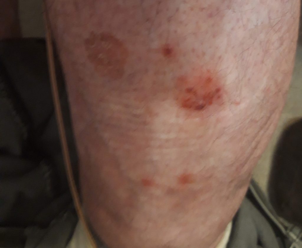 Irritated skin my Functional Electrical Stimulation story